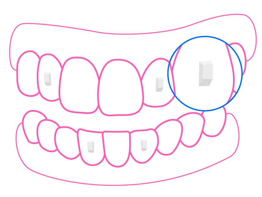 Illustration de taquets dentaires